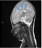 A Case Report of a New Variant Associated with Vici Syndrome in a Turkish Infant; EPG5 Frameshift Variant