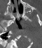 Combination of the Endoscopic Septonasal Flap Technique and Silicone Stents for Repair of Congenital Choanal Atresia in Neonates and Infants: A Prospective Study