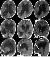 Complex Hydrocephalus in Children: Procedure of Surgical Management