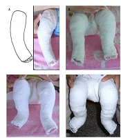 Clubfoot: A Comprehensive Review of Anatomy, Etiology, Treatment, Follow-up and Relapse