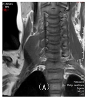 Magnetic Resonance Imaging (MRI) Features and Diagnostic Accuracy in Pediatric Brachial Plexus Neuropathy: A Retrospective Analysis