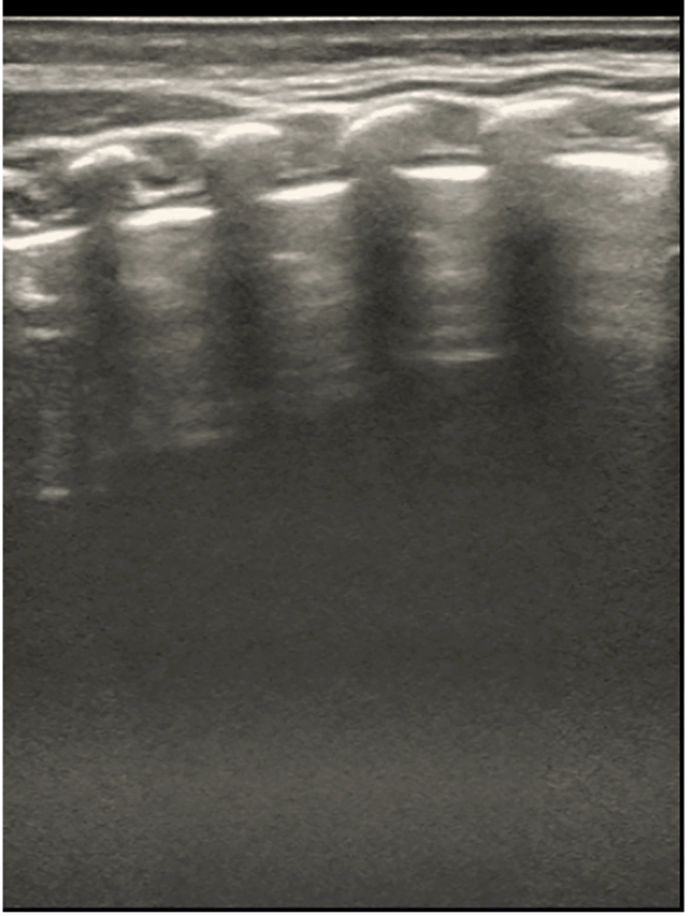 Representative ultrasound image of normal newborn lung. Normal lung aeration is indicated by the image’s parallel, evenly spaced A-lines and smooth, clear pleural lines. A Mindray M9 portable color Doppler ultrasound machine (Shenzhen Mindray Biomedical Electronics Co., Ltd., China) was used to take the pictures. Representative ultrasound image of normal newborn lung. Normal lung aeration is indicated by the image’s parallel, evenly spaced A-lines and smooth, clear pleural lines. A Mindray M9 portable color Doppler ultrasound machine (Shenzhen Mindray Biomedical Electronics Co., Ltd., China) was used to take the pictures.