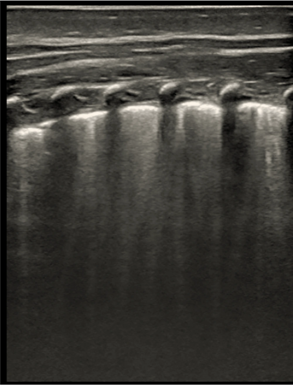 B-line artifacts in an ultrasound image. Multiple, merging B-lines, focal abnormalities of the pleural line, and no A-lines are visible in this picture. An increase in interstitial lung fluid is strongly suggested by this trend. A Mindray M9 portable color Doppler ultrasound machine (Shenzhen Mindray Biomedical Electronics Co., Ltd., China) was used to take the pictures. B-line artifacts in an ultrasound image. Multiple, merging B-lines, focal abnormalities of the pleural line, and no A-lines are visible in this picture. An increase in interstitial lung fluid is strongly suggested by this trend. A Mindray M9 portable color Doppler ultrasound machine (Shenzhen Mindray Biomedical Electronics Co., Ltd., China) was used to take the pictures.