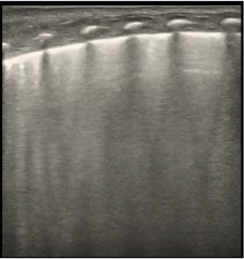Alveolar-interstitial syndrome (AIS) is depicted in an ultrasound image. Findings consistent with AIS are seen in the scan, including localized thickening and blurring of the pleural line, total lack of A-lines, and lack of lung consolidation. A Mindray M9 portable color Doppler ultrasound machine (Shenzhen Mindray Biomedical Electronics Co., Ltd., China) was used to take the pictures. Alveolar-interstitial syndrome (AIS) is depicted in an ultrasound image. Findings consistent with AIS are seen in the scan, including localized thickening and blurring of the pleural line, total lack of A-lines, and lack of lung consolidation. A Mindray M9 portable color Doppler ultrasound machine (Shenzhen Mindray Biomedical Electronics Co., Ltd., China) was used to take the pictures.