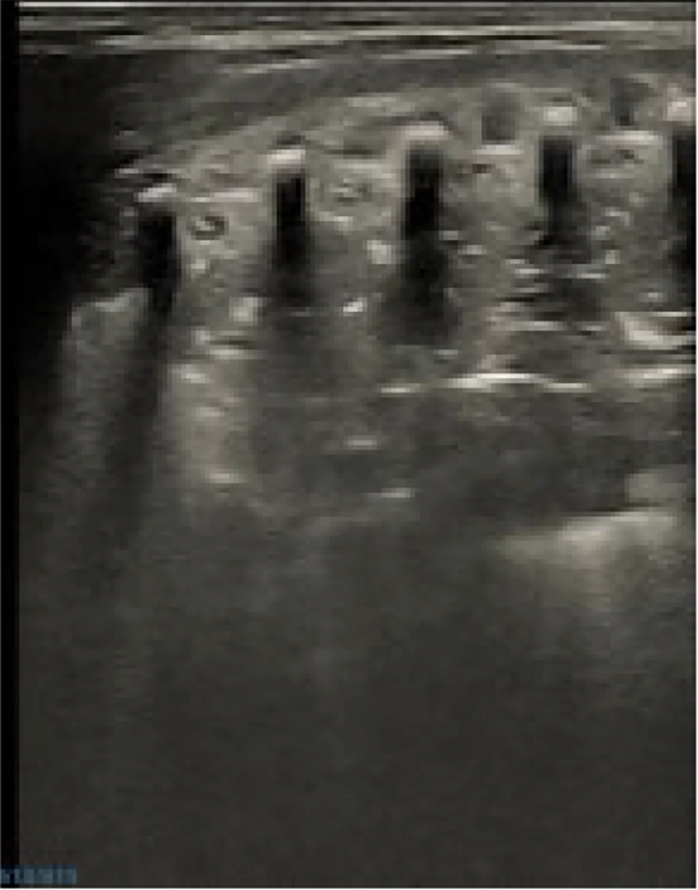 Ultrasound image indicative of neonatal respiratory distress syndrome (NRDS). Large-scale lung consolidation with noticeable air bronchograms, no A-lines, and either thicker or absent pleural lines are all present in this image, which is consistent with NRDS. The NRDS can be diagnosed by combining clinical case characteristics. A Mindray M9 portable color Doppler ultrasound machine (Shenzhen Mindray Biomedical Electronics Co., Ltd., China) was used to take the pictures. Ultrasound image indicative of neonatal respiratory distress syndrome (NRDS). Large-scale lung consolidation with noticeable air bronchograms, no A-lines, and either thicker or absent pleural lines are all present in this image, which is consistent with NRDS. The NRDS can be diagnosed by combining clinical case characteristics. A Mindray M9 portable color Doppler ultrasound machine (Shenzhen Mindray Biomedical Electronics Co., Ltd., China) was used to take the pictures.