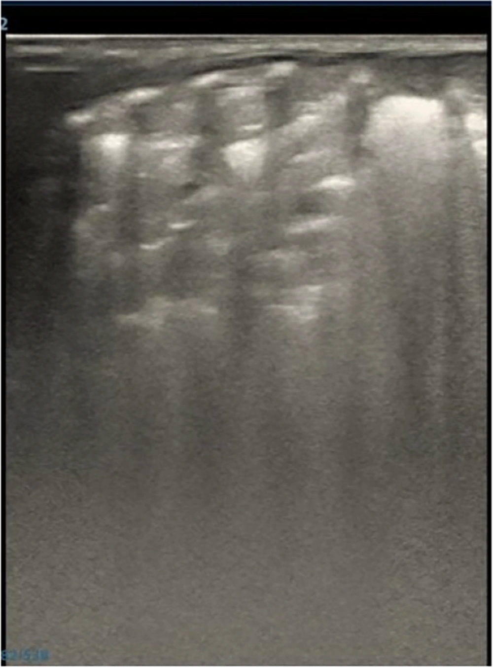Ultrasound image suggestive of neonatal pulmonary hemorrhage (NPH). With fragmented tissue-like patterns, prominent air bronchograms, no A-lines, and either absent or thicker pleural lines — all of which are indicative of NPH — the image displays heterogeneous echogenicity. Pneumonia can be diagnosed by combining clinical case characteristics. A Mindray M9 portable color Doppler ultrasound machine (Shenzhen Mindray Biomedical Electronics Co., Ltd., China) was used to take the pictures. Ultrasound image suggestive of neonatal pulmonary hemorrhage (NPH). With fragmented tissue-like patterns, prominent air bronchograms, no A-lines, and either absent or thicker pleural lines — all of which are indicative of NPH — the image displays heterogeneous echogenicity. Pneumonia can be diagnosed by combining clinical case characteristics. A Mindray M9 portable color Doppler ultrasound machine (Shenzhen Mindray Biomedical Electronics Co., Ltd., China) was used to take the pictures.