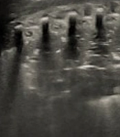 Iran J Pediatr