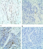 Programmed Death Ligand-1 (PD-L1) Expression in Neuroblastoma: A Single Pediatric Oncology Center Experience
