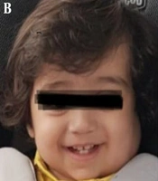 Bleomycin Efficacy in Treatment of Head and Neck Lymphatic Malformations: Case Series of Patients Presenting to a Tertiary Children's Hospital in Iran from 2017 to 2021