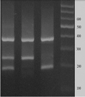 Association Between UGT1A1 Gene Polymorphisms and Neonatal Hyperbilirubinemia