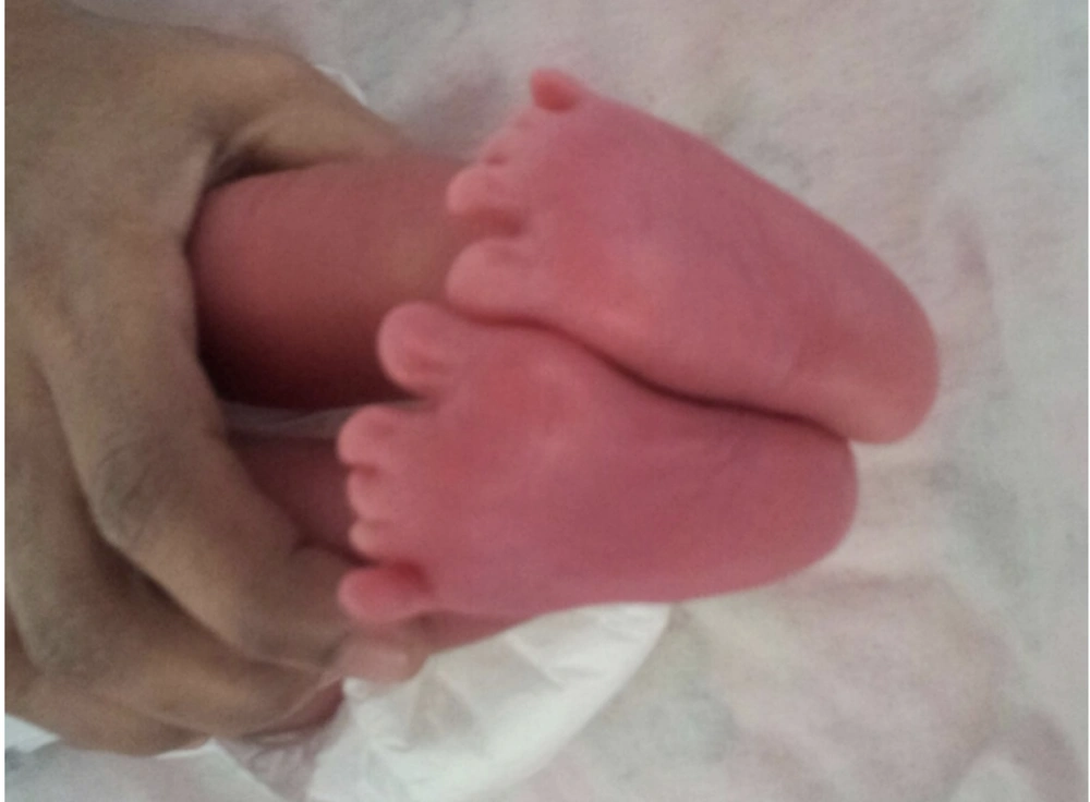 showing small sized medial four toes of both lower limbs, constriction bands around the fingers, distal atrophy of fingers with absence of nails in all toes. Also note little toe is large in size than other toes of lower limbs. showing small sized medial four toes of both lower limbs, constriction bands around the fingers, distal atrophy of fingers with absence of nails in all toes. Also note little toe is large in size than other toes of lower limbs.