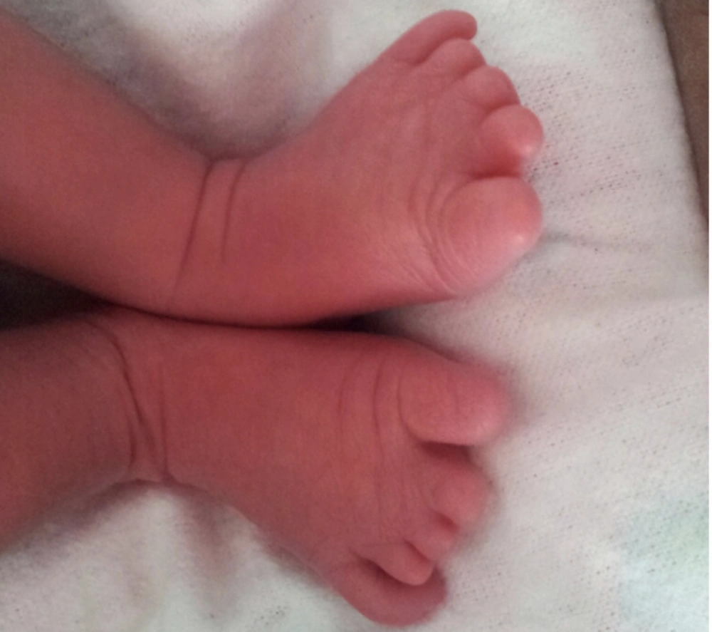 showing small sized medial four toes of both lower limbs, constriction bands around the fingers, distal atrophy of fingers with absence of nails in all toes. Also note little toe is large in size than other toes of lower limbs showing small sized medial four toes of both lower limbs, constriction bands around the fingers, distal atrophy of fingers with absence of nails in all toes. Also note little toe is large in size than other toes of lower limbs