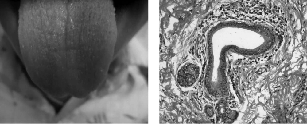Dry and Fissured Tongue, Minor Salivary Gland Biopsy Showing Salivary Acini and Periductal Lymphocytic and Plasma Cell Infiltration Dry and Fissured Tongue, Minor Salivary Gland Biopsy Showing Salivary Acini and Periductal Lymphocytic and Plasma Cell Infiltration