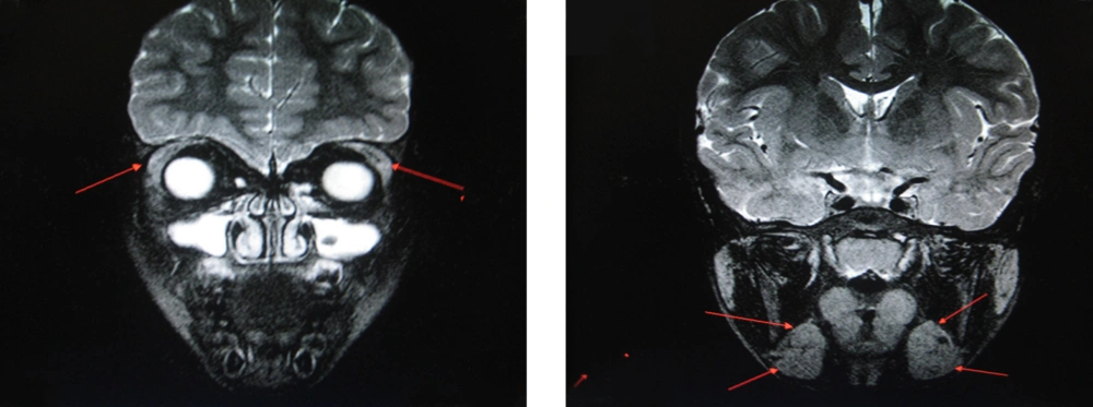 MRI Showing Enlarged and Hyperintense Submandibular and Lacrimal Glands on T1 Images MRI Showing Enlarged and Hyperintense Submandibular and Lacrimal Glands on T1 Images