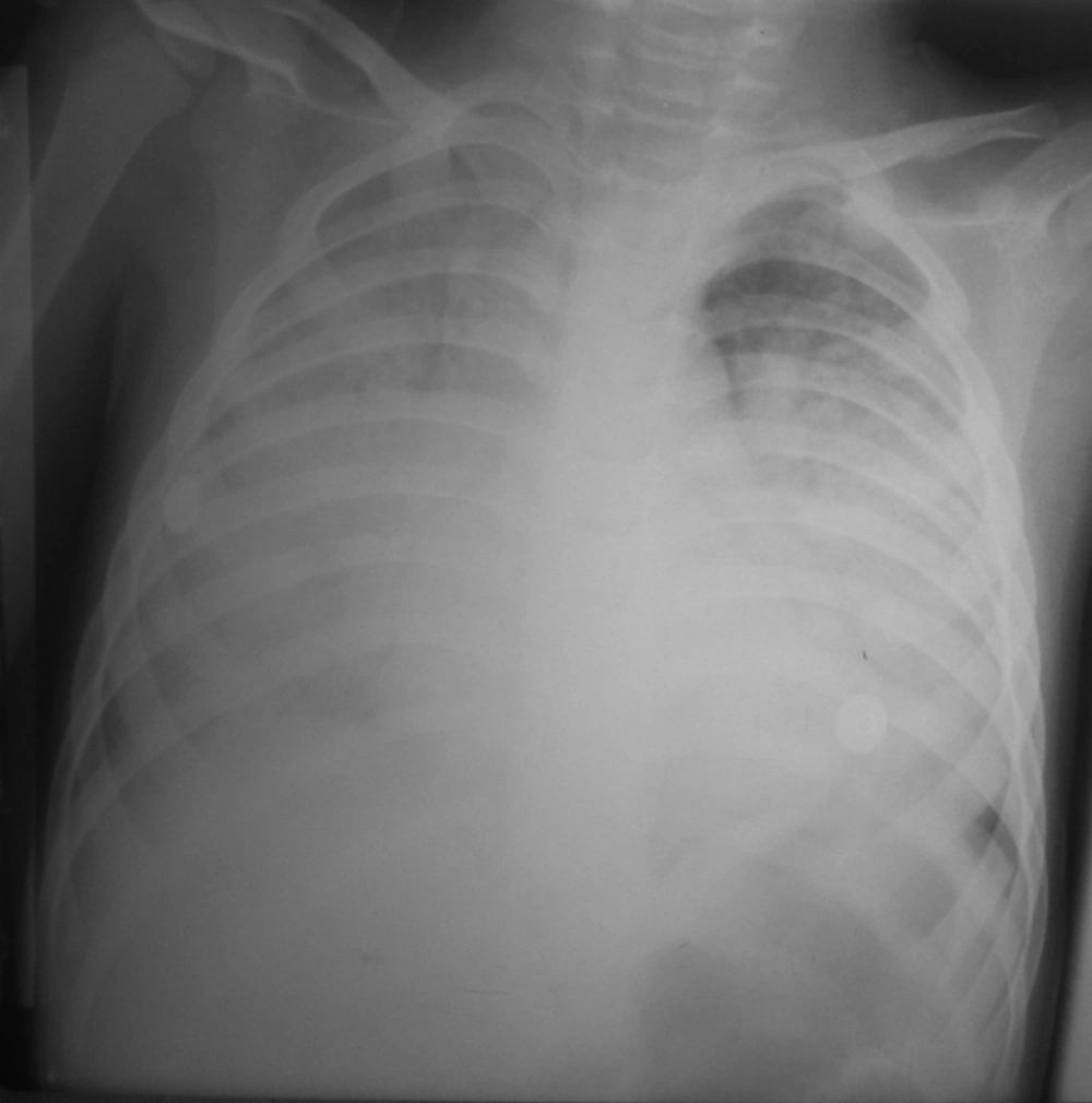 Simple Anteroposterior Chest X-Ray Demonstrating Bilateral Opacities, Mostly in the Lower Lobes Simple Anteroposterior Chest X-Ray Demonstrating Bilateral Opacities, Mostly in the Lower Lobes