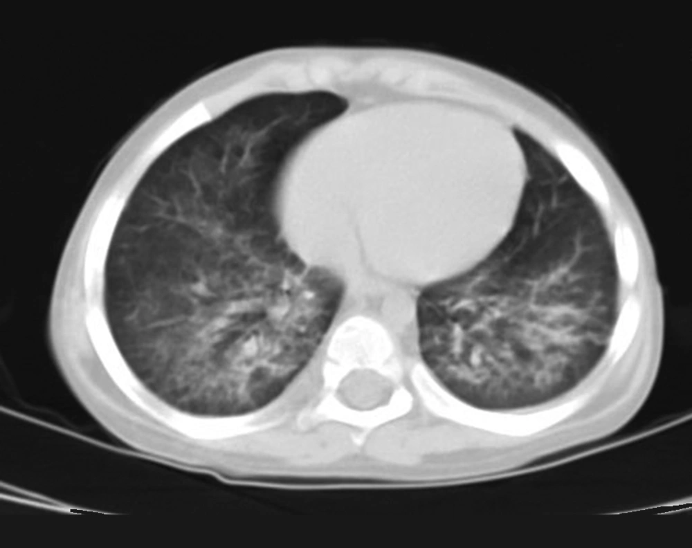High-Resolution Computed Tomography Scan of the Chest Showing Dramatic Improvement in Both Lungs After Multiple Segmental BAL High-Resolution Computed Tomography Scan of the Chest Showing Dramatic Improvement in Both Lungs After Multiple Segmental BAL