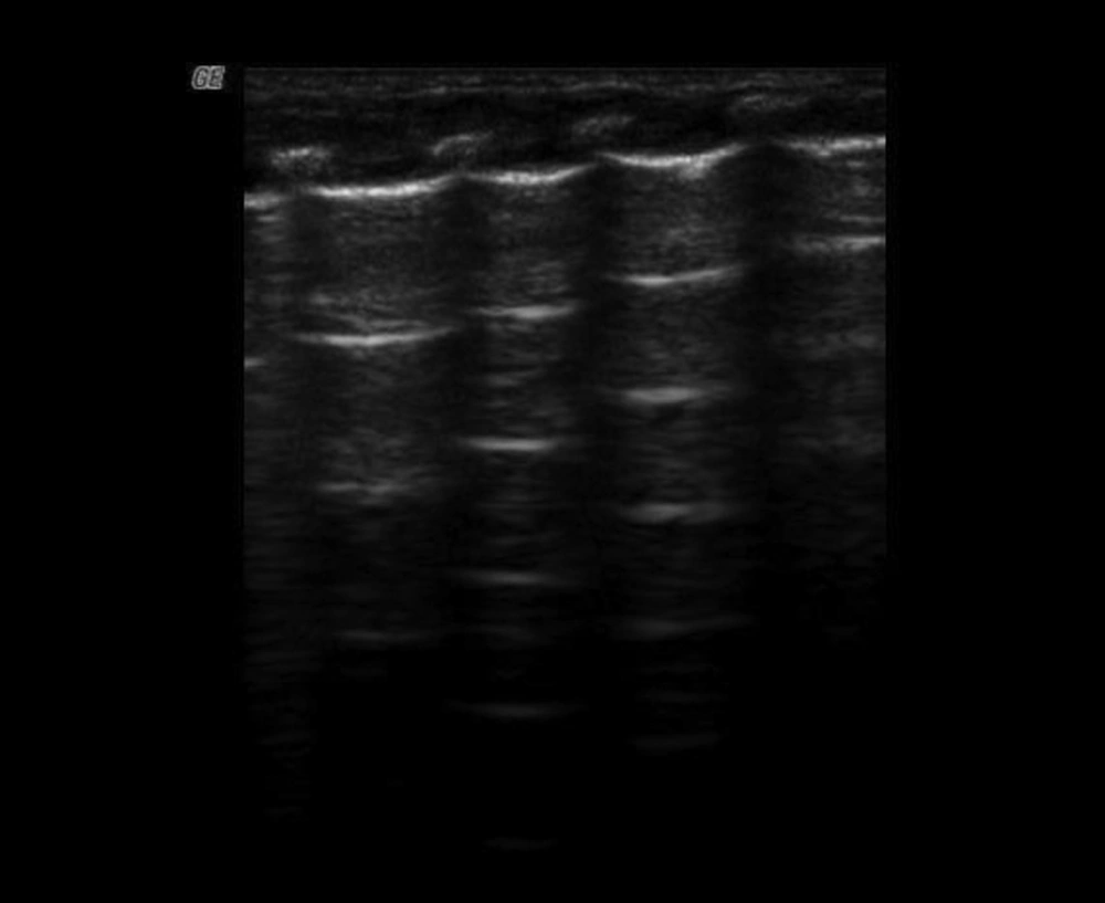 Normal Lung Ultrasound Appearance: Gestational Age 73<sup>+5</sup> Weeks, Birth Weight 2570 g Longitudinal scan of the thorax, noting the ‘black’ normal lung and the echogenic line of normal pleura, paralleled A-lines and curvilinear appearance of the ribs associated with posterior acoustic shadowing. B-lines cannot be found in this infant.