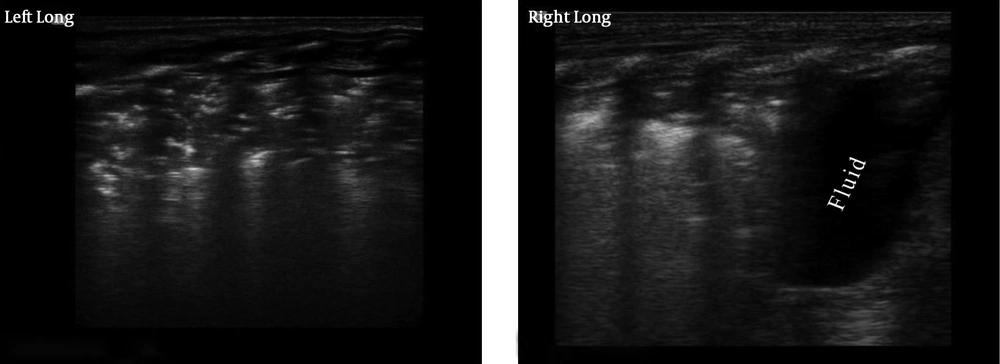 Different Ultrasound Appearance of Grade IV RDS Bilaterally in Lungs Different Ultrasound Appearance of Grade IV RDS Bilaterally in Lungs