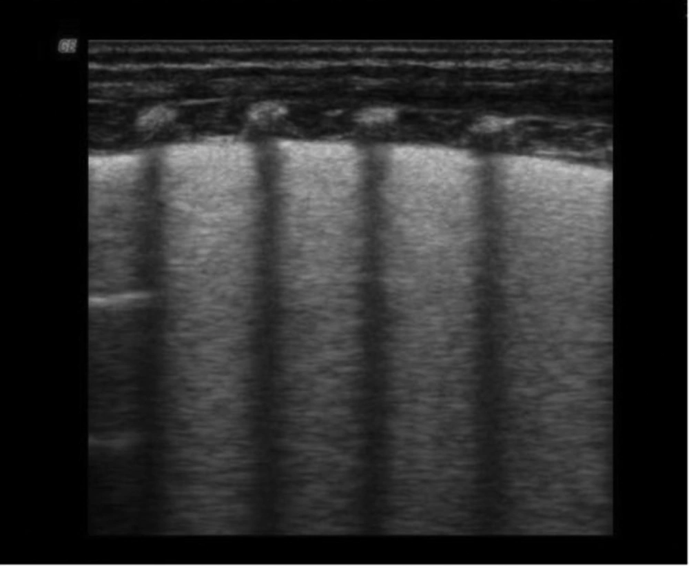 Ultrasound Image of White Lung (AIS) Ultrasound Image of White Lung (AIS)