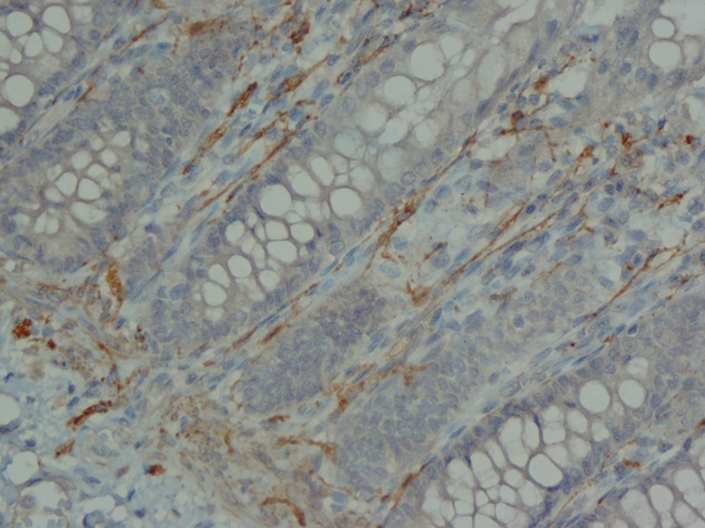Low Power View of Full Wall Thickness Section Shows Calretinin Immunoreactivity in Lamina Propria, Submucosa and Muscularis Propria (× 100) Low Power View of Full Wall Thickness Section Shows Calretinin Immunoreactivity in Lamina Propria, Submucosa and Muscularis Propria (× 100)