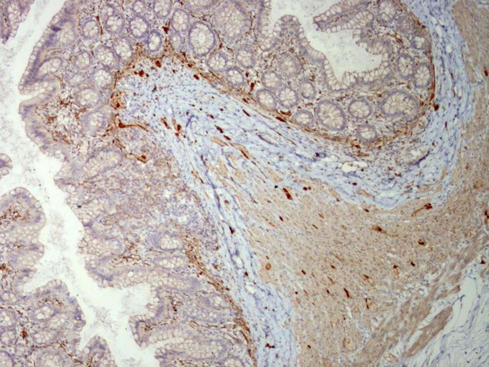 Lamina Propria Shows Calretinin Immunoreactivity in Nerve Fibers (× 250) Lamina Propria Shows Calretinin Immunoreactivity in Nerve Fibers (× 250)