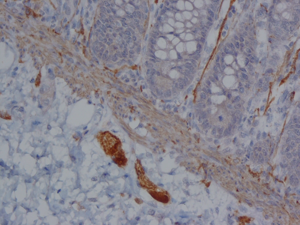 Strong Cytoplasmic and Nuclear Calretinin Immunoreactivity in Ganglion Cells of Submucosa (× 250) Strong Cytoplasmic and Nuclear Calretinin Immunoreactivity in Ganglion Cells of Submucosa (× 250)