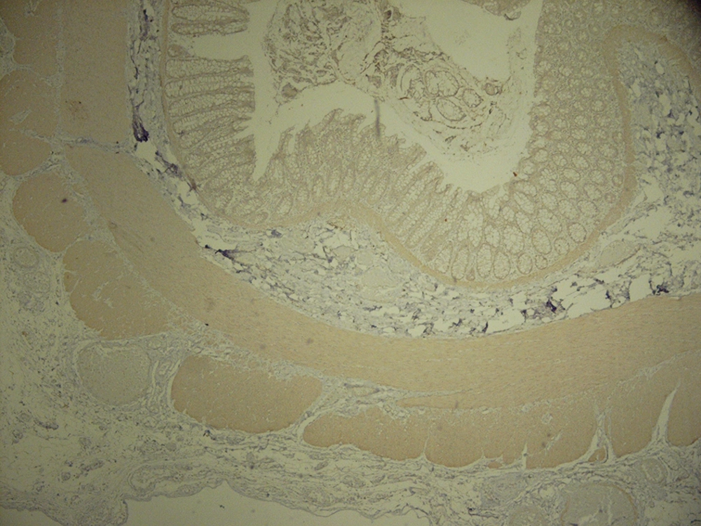 Low Power View of Full Wall Thickness Section Shows no Calretinin Immunoreactivity in Lamina Propria, Submucosa and Muscularis Propria (× 40) Low Power View of Full Wall Thickness Section Shows no Calretinin Immunoreactivity in Lamina Propria, Submucosa and Muscularis Propria (× 40)