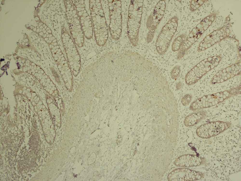 Submucosa Shows no Calretinin Immunoreactivity in Nerve Fibers and Ganglion Cells (× 100) Submucosa Shows no Calretinin Immunoreactivity in Nerve Fibers and Ganglion Cells (× 100)