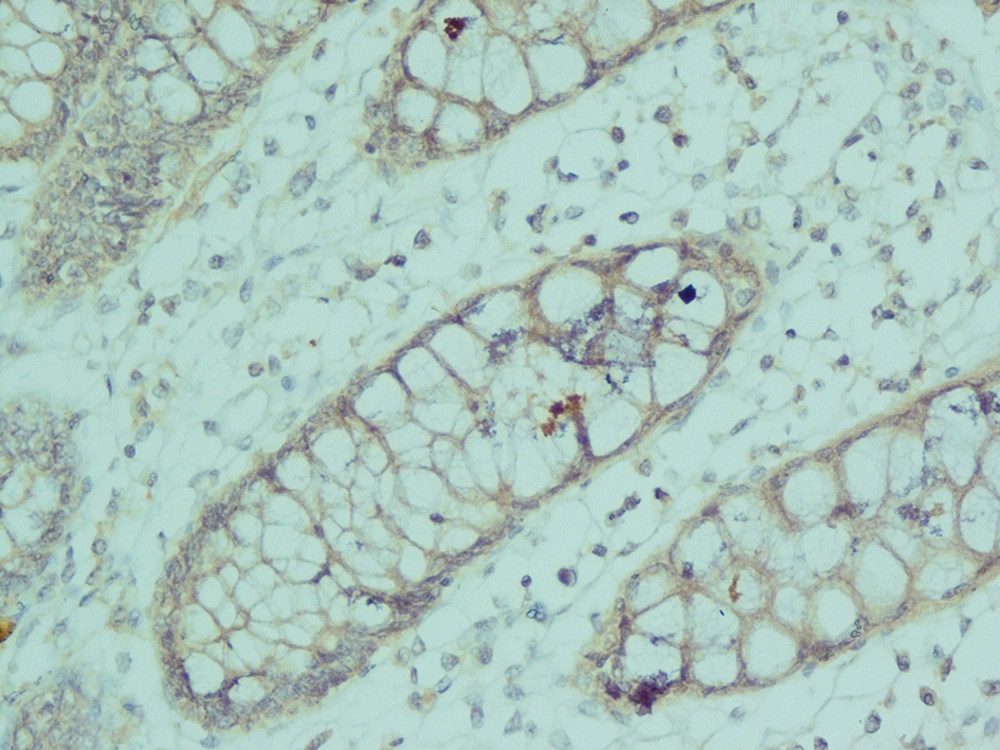 Lamina Propria Shows no Calretinin Immunoreactivity in Nerve Fibers (× 400) Lamina Propria Shows no Calretinin Immunoreactivity in Nerve Fibers (× 400)