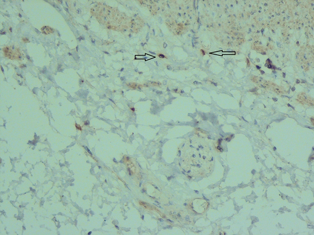Submucosa Shows Two Mast Cells (Arrow) Which are Stained by Calretinin and can be Used as Positive Control (× 400) Submucosa Shows Two Mast Cells (Arrow) Which are Stained by Calretinin and can be Used as Positive Control (× 400)