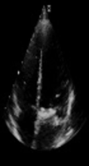Cover image of the article: Widespread Valvular and Vascular Calcification in Type III Gaucher Disease