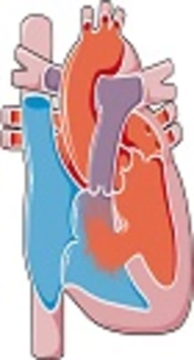 Early Surgical Closure of the Ventricular Septal Defects; to Be Done or Not to Be Done? A Question to Be Answered