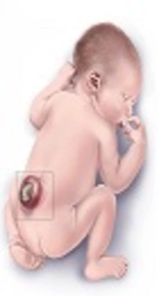 Cover image of the article: The Incidence of Upper Urinary Tract Deterioration among Iranian Neonates with Spinal Dysraphism