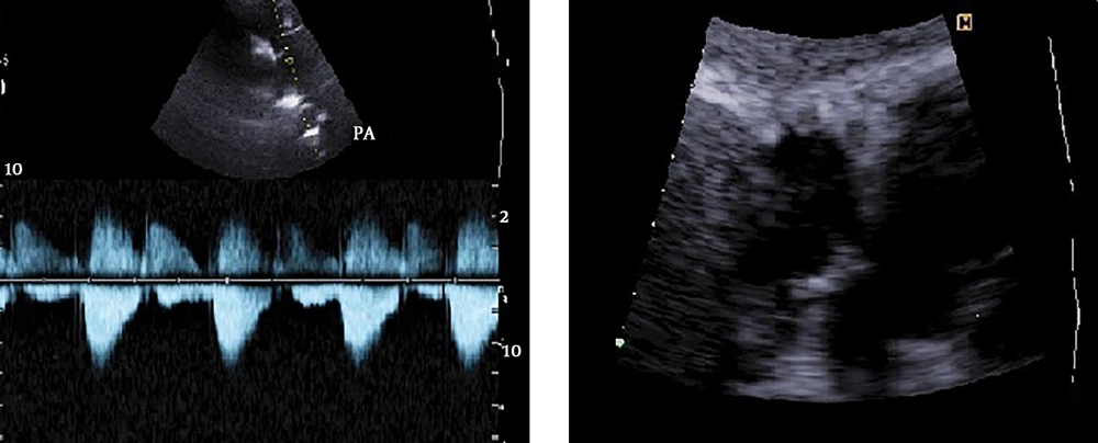 Echocardiography prior to surgery indication: large ASD secundum and pulmonary valve stenosis Echocardiography prior to surgery indication: large ASD secundum and pulmonary valve stenosis