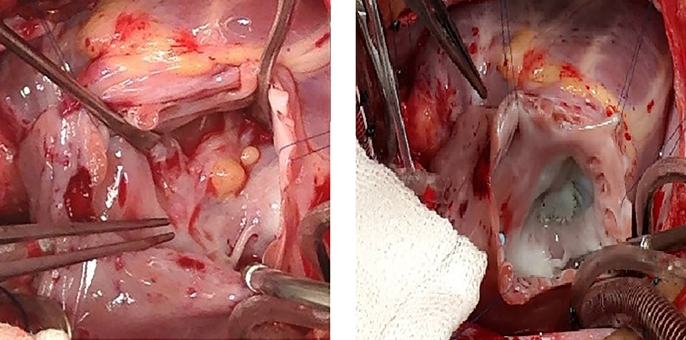 Macroscopic view of cardiac mass on septal leaflet of tricuspid valve and ASD closure and mass resection after the surgery Macroscopic view of cardiac mass on septal leaflet of tricuspid valve and ASD closure and mass resection after the surgery