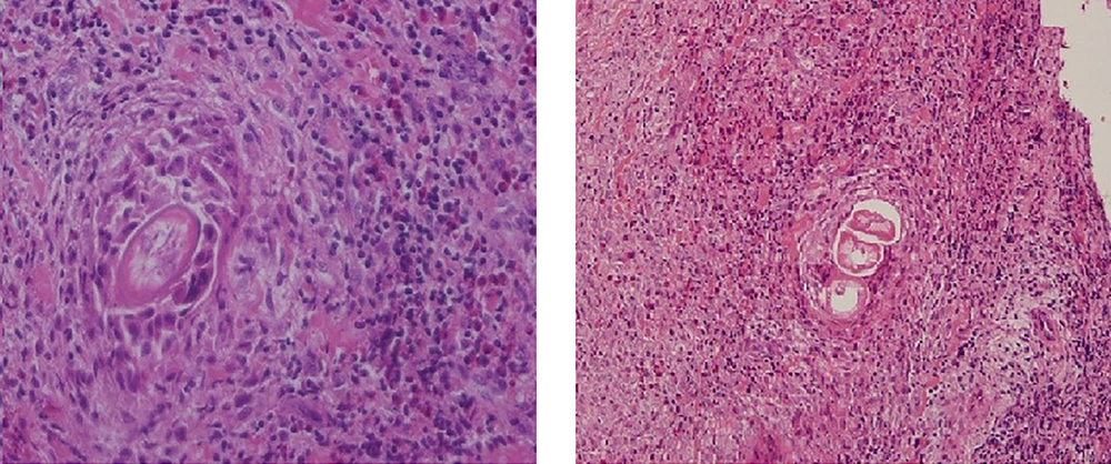 Histopathological findings of the resected mass demonstrating necrotic material, infiltration of eosinophils and larval element Histopathological findings of the resected mass demonstrating necrotic material, infiltration of eosinophils and larval element