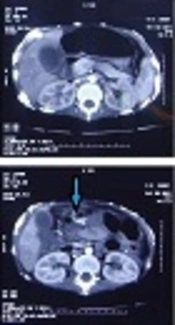 Gastrointestinal Calcinosis as a Rare Cause of Death in Juvenile Polymyositis