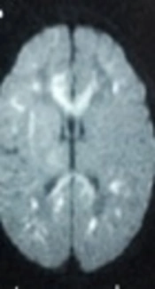 Cover image of the article: Clinical Characteristics, Diagnosis and Management of Neonatal Stroke