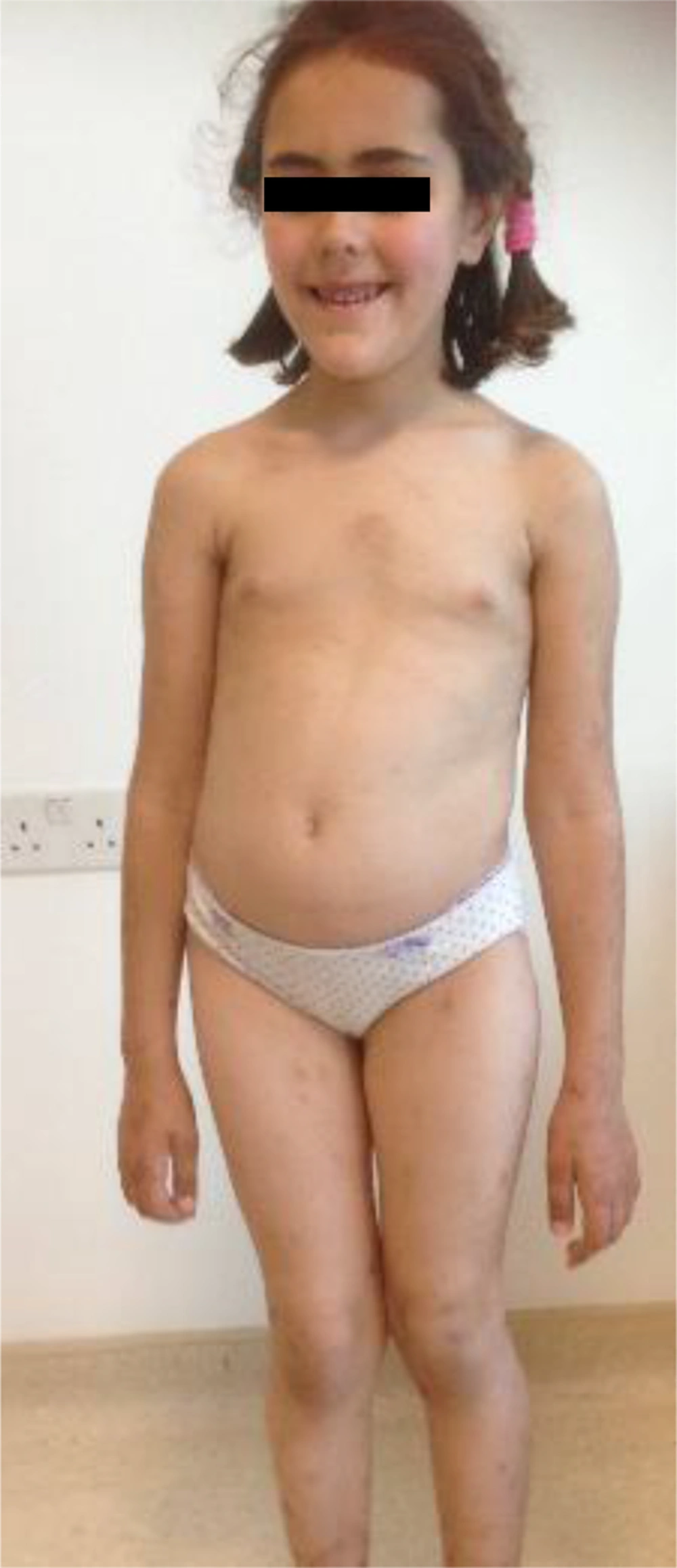 Dysmorphic Facial Features; Long Face, High Forehead, High Frontal Hairline, Prominent Jaw, Down-Slanting Palpebral Fissures and Rash Were Noted on Physical Examination Dysmorphic Facial Features; Long Face, High Forehead, High Frontal Hairline, Prominent Jaw, Down-Slanting Palpebral Fissures and Rash Were Noted on Physical Examination