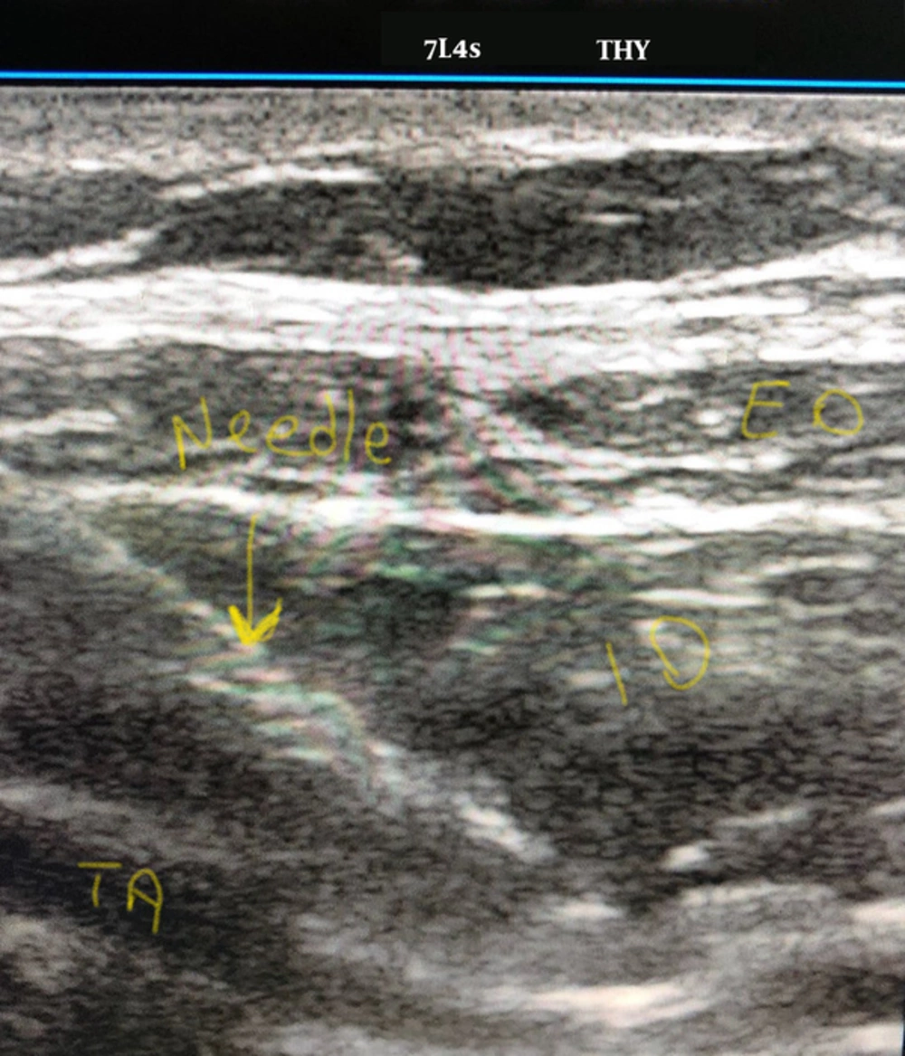 Picture of ultrasound guided ilioinguinal/iliohypogastric nerve block Picture of ultrasound guided ilioinguinal/iliohypogastric nerve block