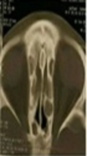 Sinonasal Manifestations in Children with Cystic Fibrosis