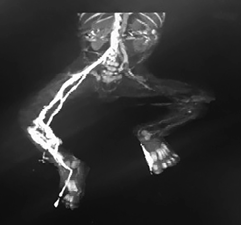 CT angiography of the patient CT angiography of the patient