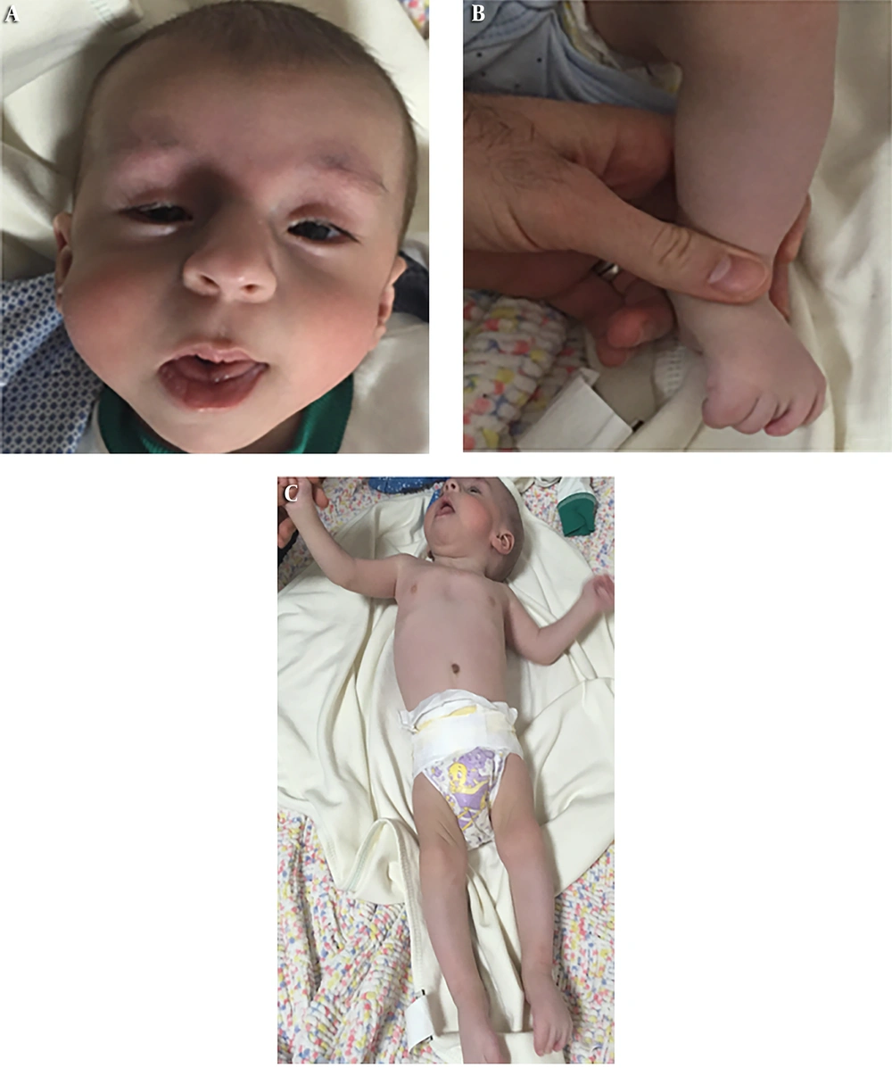 Phenotypic characteristics of proband. A, Microcephaly, low set ears, micrognathia, triangular facial structure, bilateral ptosis, prominent nasal structure, full cheeks; B, elongated foot structure; and C, hypertonicity, widely spaced nipples, pectus excavatum, arachnodactyly. Phenotypic characteristics of proband. A, Microcephaly, low set ears, micrognathia, triangular facial structure, bilateral ptosis, prominent nasal structure, full cheeks; B, elongated foot structure; and C, hypertonicity, widely spaced nipples, pectus excavatum, arachnodactyly.