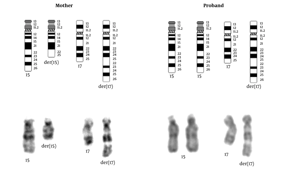 Rearranged chromosomes of the mother and proband Rearranged chromosomes of the mother and proband