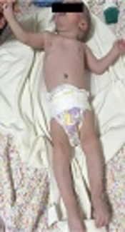Partial Trisomy 15q and Partial Monosomy 17q in a Boy with Various Dysmorphic Findings