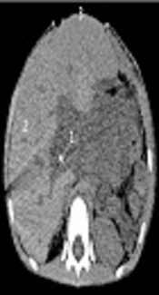 Huge Liver Tumor - Therapy Outside the Guidelines
