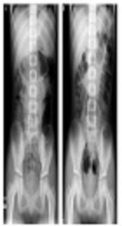 Utility of Lubiprostone for Japanese Children with Functional Constipation