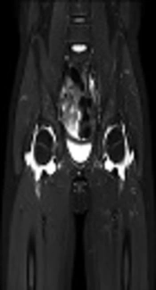 Clinical Significance of Late Onset Arthritis in Kawasaki Disease