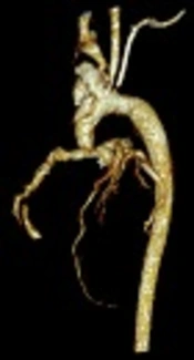 Ascending Aorta and Total Aortic Arch Replacement in a Child with Infective Endarteritis