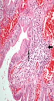 Place of Cholecystectomy in Children with Uncomplicated Gallstones